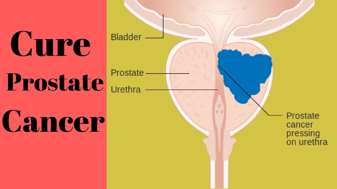 07 Very Effective Tips To Prevent And Cure Prostate Cancer ...