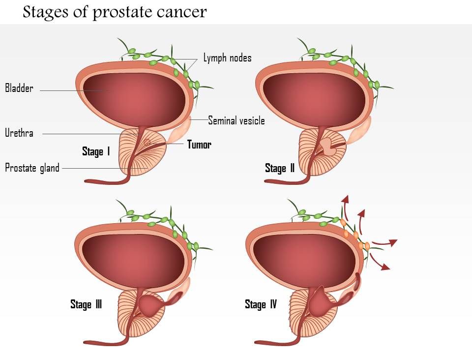 0914 Stages Of Prostate Cancer Medical Images For ...