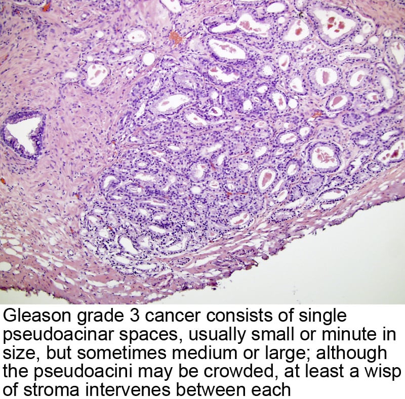 Adenocarcinoma prostate gleason score 8 Share Link