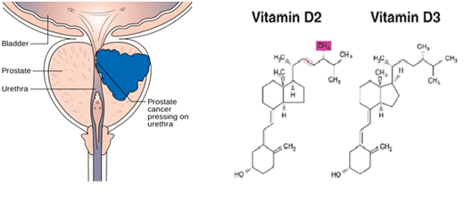 Aggressive prostate cancer can be caused by vitamin D ...