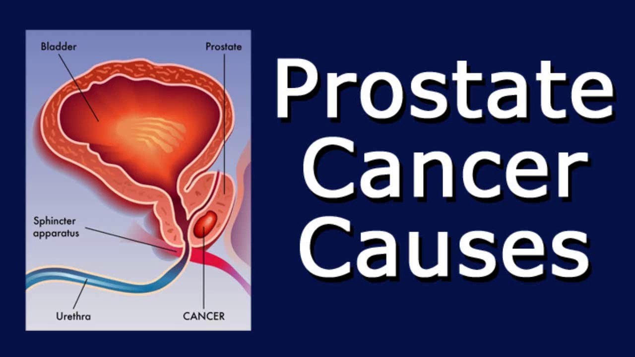 All You Need To Know About Causes Of Prostate Cancer ...