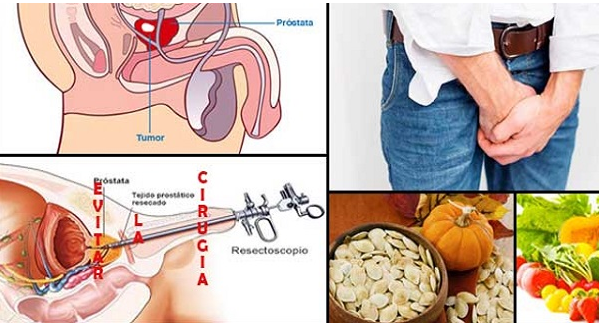 Attention! Forget Prostate Pain and Avoid Painful Surgery Using These 2 ...
