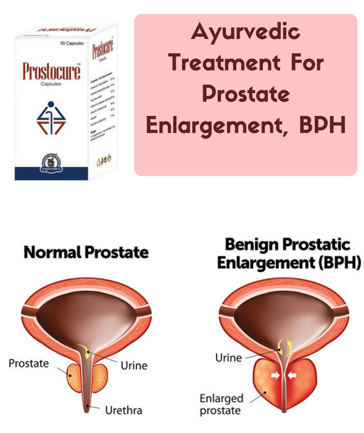 Ayurvedic Treatment For Prostate Enlargement, BPH