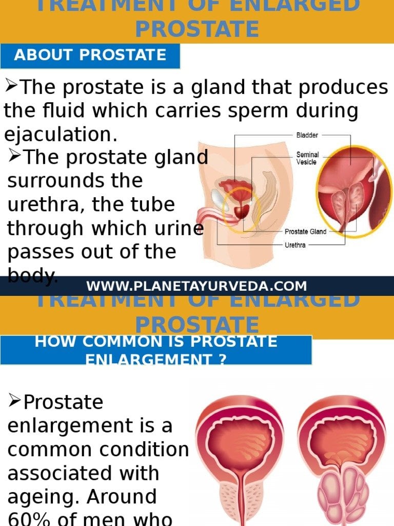 Ayurvedic Treatment of Enlarged Prostate Gland