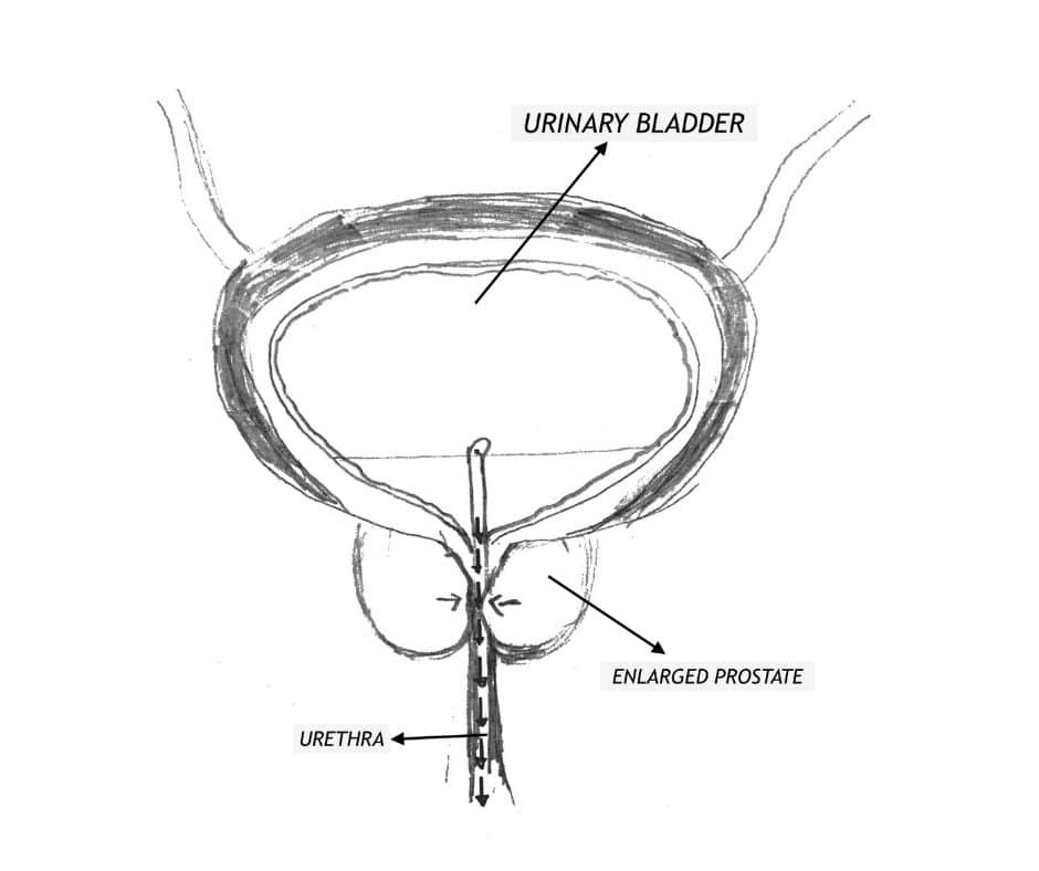 Benign Prostate Hyperplasia/Enlargement