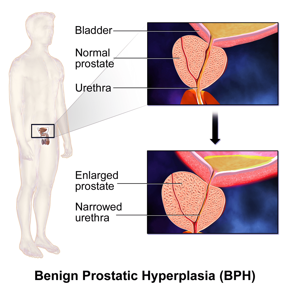 Benign Prostatic Hyperplasia Causes, Sign &  Symptoms