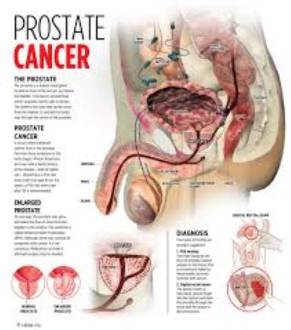 Black Men Are Naive Of Prostate Cancer And Dying Of The Cancer When ...
