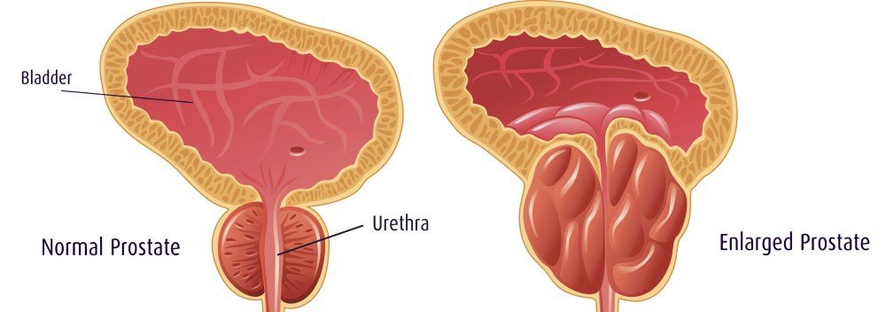Can An Enlarged Prostate Cause Urinary Tract Infections UTIs?