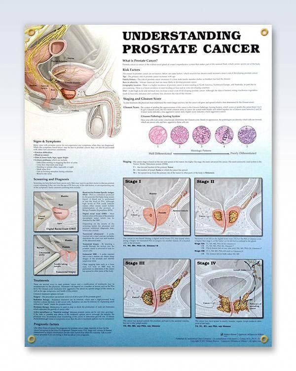 Can Mesothelioma Cause Prostate Cancer