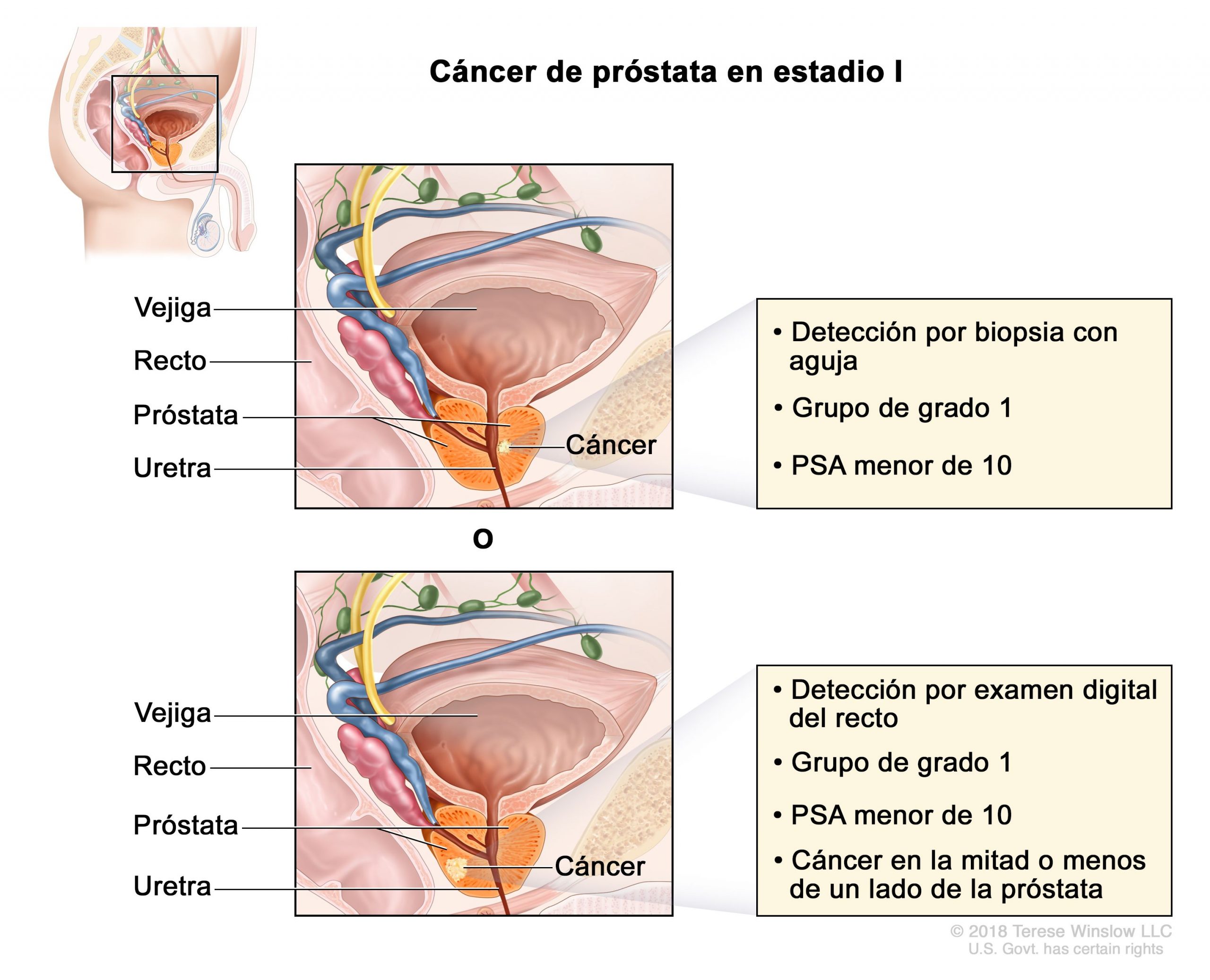 Cancer de prostata fisiopatologia