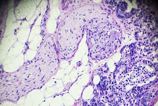 Cancer Of Prostate Biopsy Under Microscopy Stock Photo ...