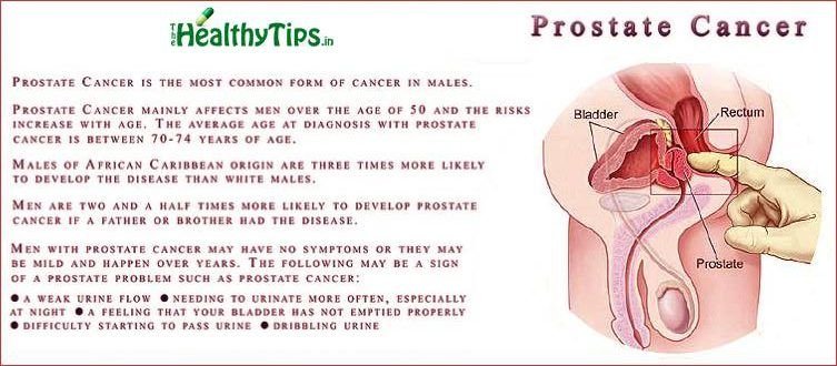 Causes And Symptoms Of Prostate Cancer