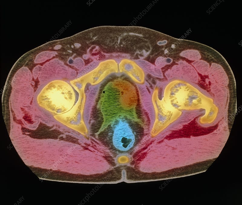 Coloured MRI scan showing prostate cancer
