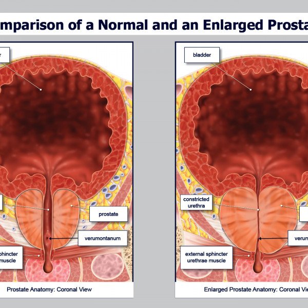 Comparison of a Normal and an Enlarged Prostate