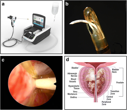Convective Radiofrequency Water Vapor Thermal Therapy with ...