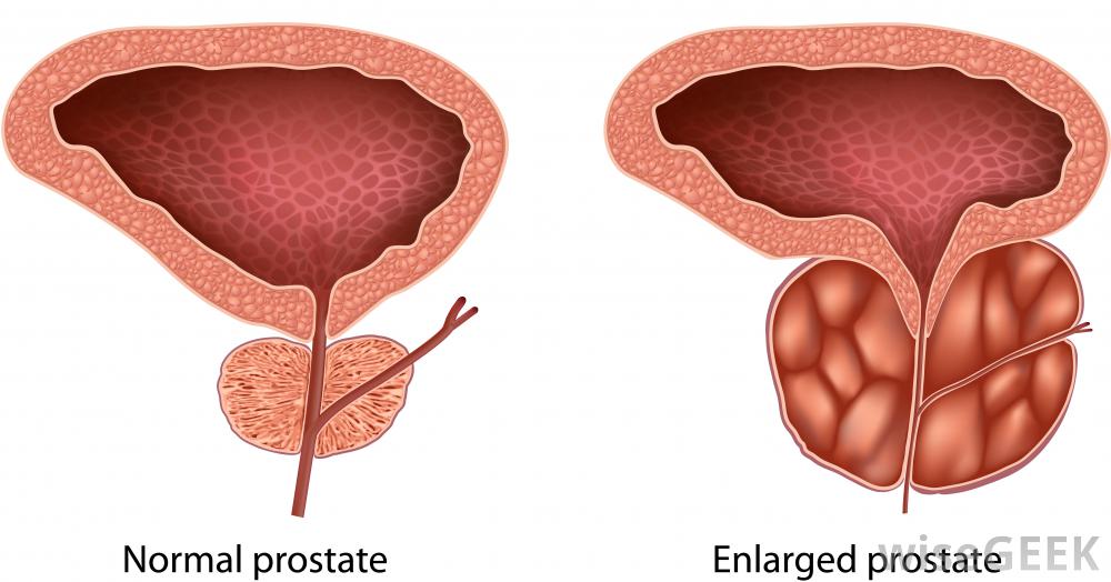 Correct Enlarged Prostate Problems Naturally With No Side ...