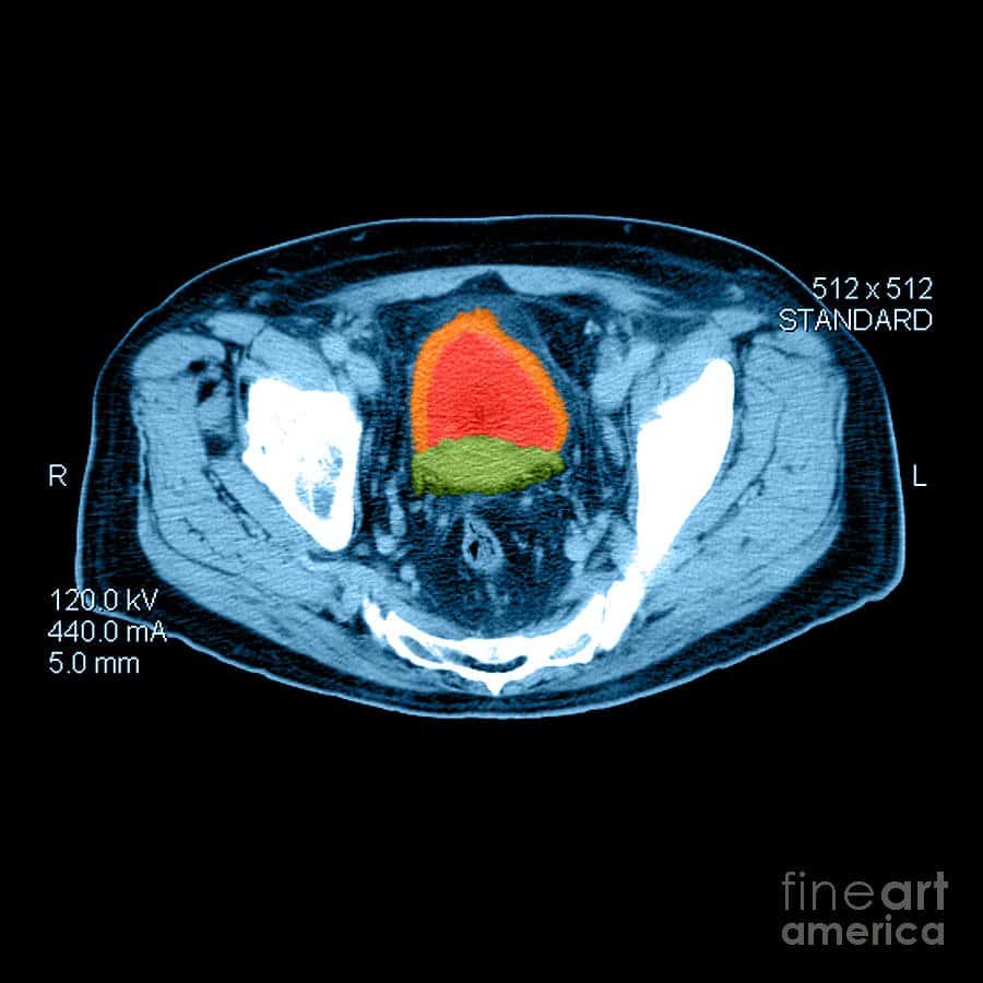 Ct Scan For Prostate Cancer