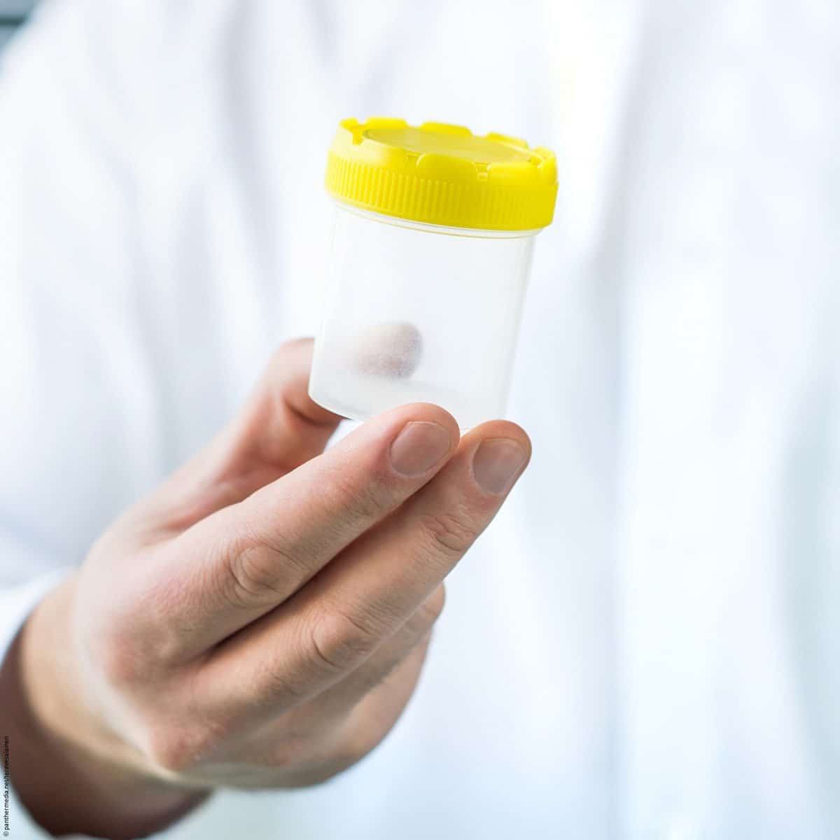 Diagnostics: New home urine test for prostate cancer