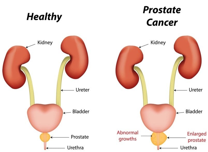 Disease Graphics, Videos &  Images on Prostate Cancer