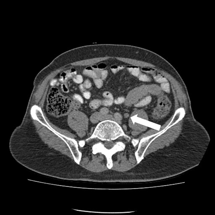 Does Pelvic Ct Scan Show Prostate Cancer