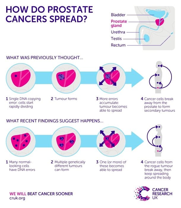 Does Prostate Cancer Spread