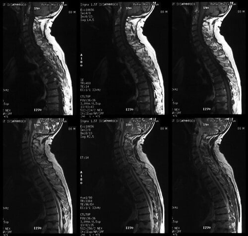 Double cord compression, prostate metastases, MRI upper sp