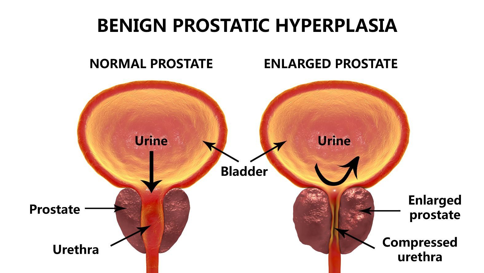 Enlarged Prostate Gland: Overview  Vastmedic