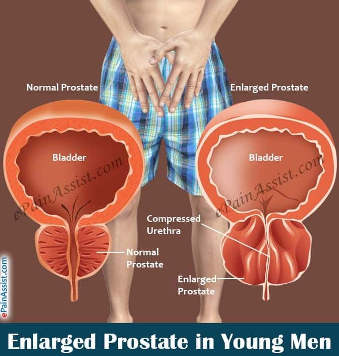 Enlarged Prostate in Young Men