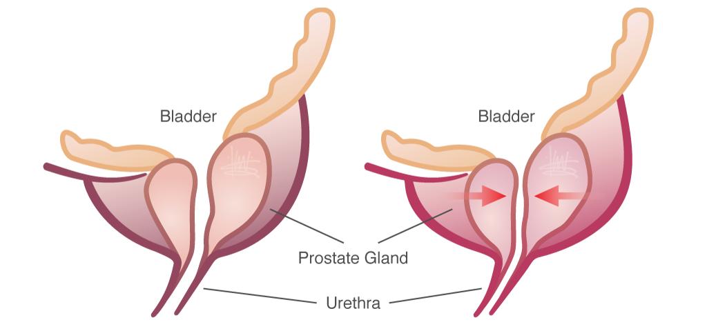 Enlarged Prostate Symptoms and Treatments â ClinicalPosters