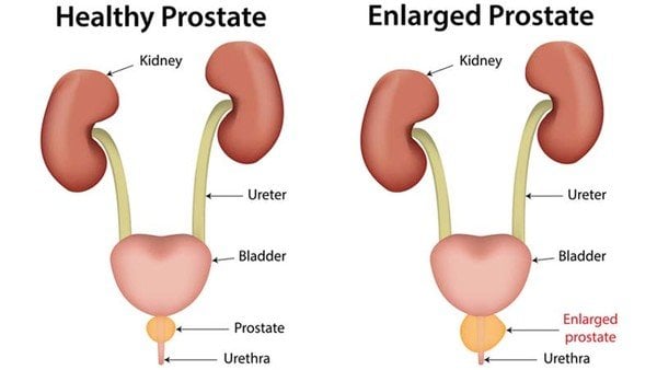 Enlarged Prostate: When To Get Worried and When To Just Relax