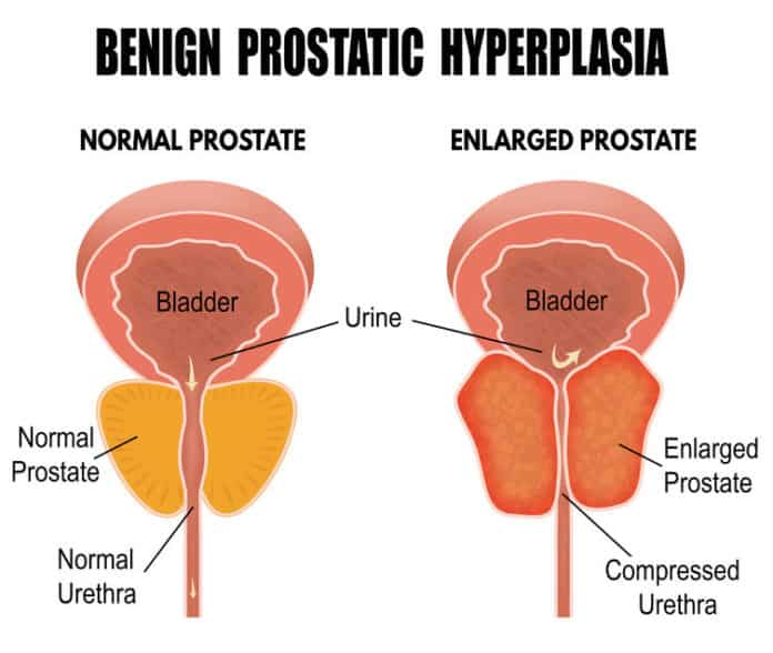 Enlarged Prostate: Which is the best treatment option?