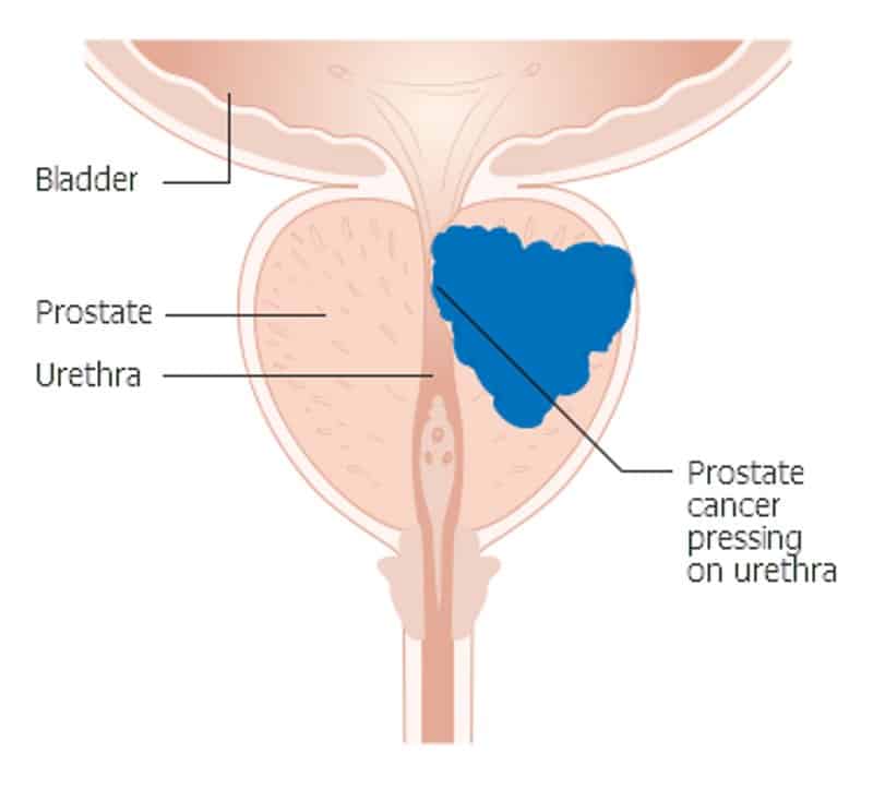 Facts You Should Know about Prostate Cancer