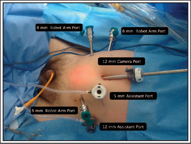 Figure 2 from Robot assisted radical prostatectomy: how I ...