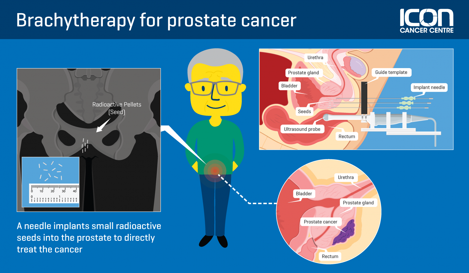 Focal brachytherapy for prostate cancer â Icon Cancer Centre