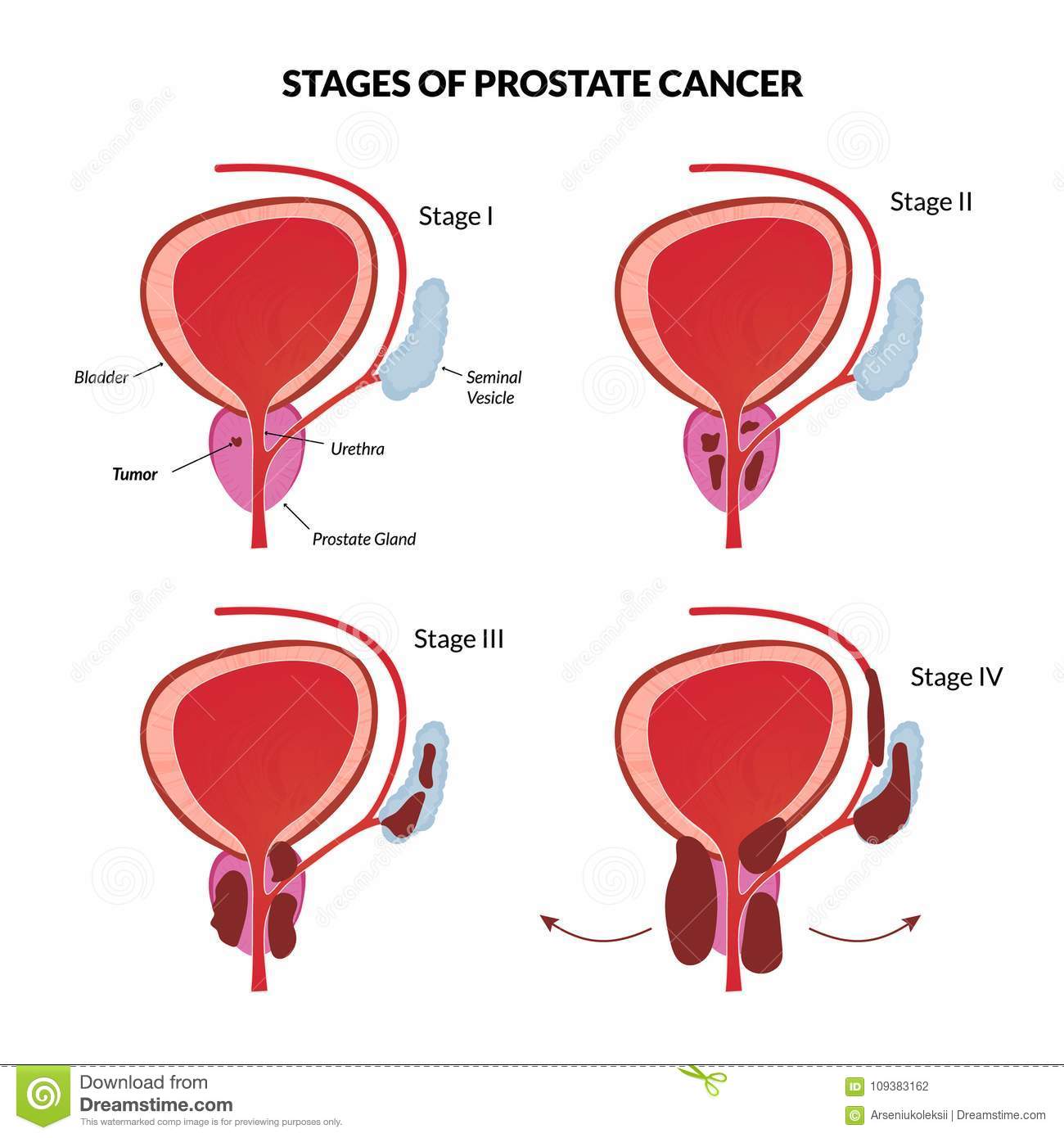 Four Stages Of Prostate Cancer Stock Vector