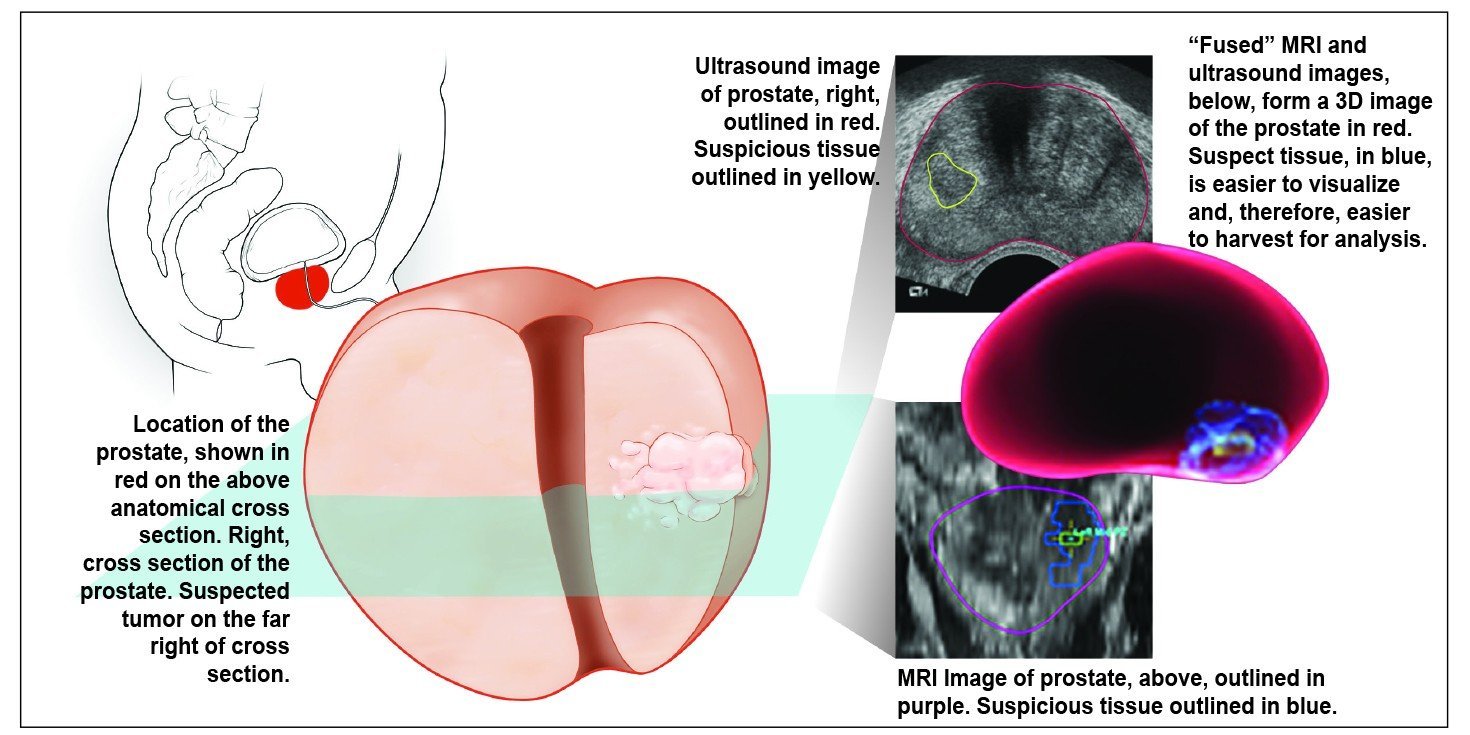 fused technologies give 3d view of prostate during biopsy article
