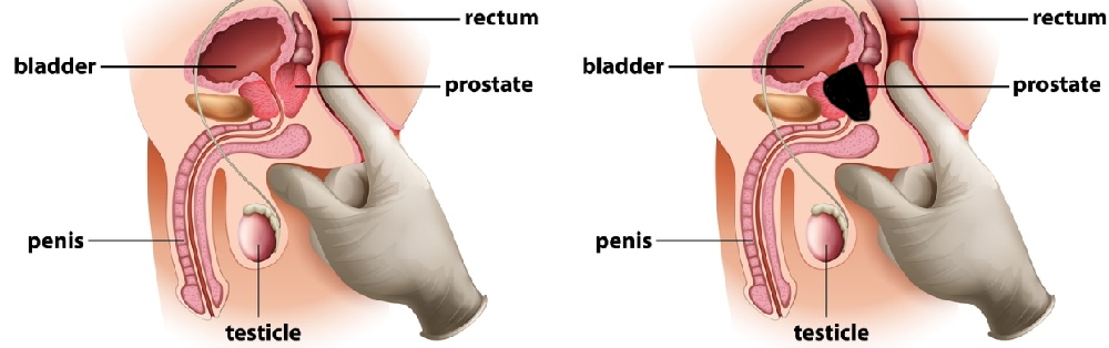 Help! Prostate out of reach if aroused... : ProstatePlay