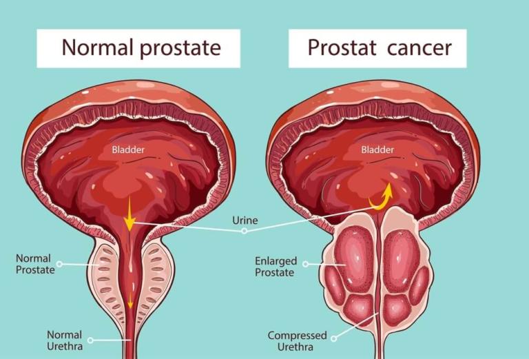 How long does Erectile Dysfunction last after Prostate ...