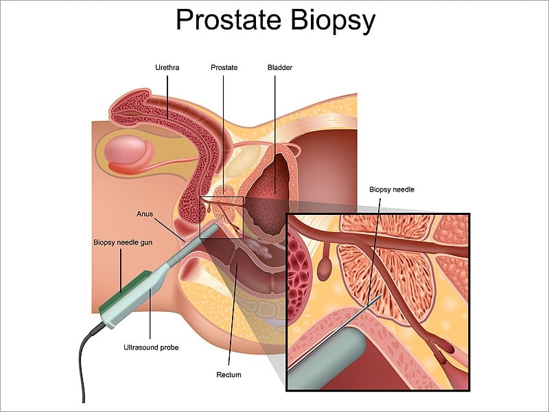 Infection on the Rise After Transrectal Prostate Biopsy