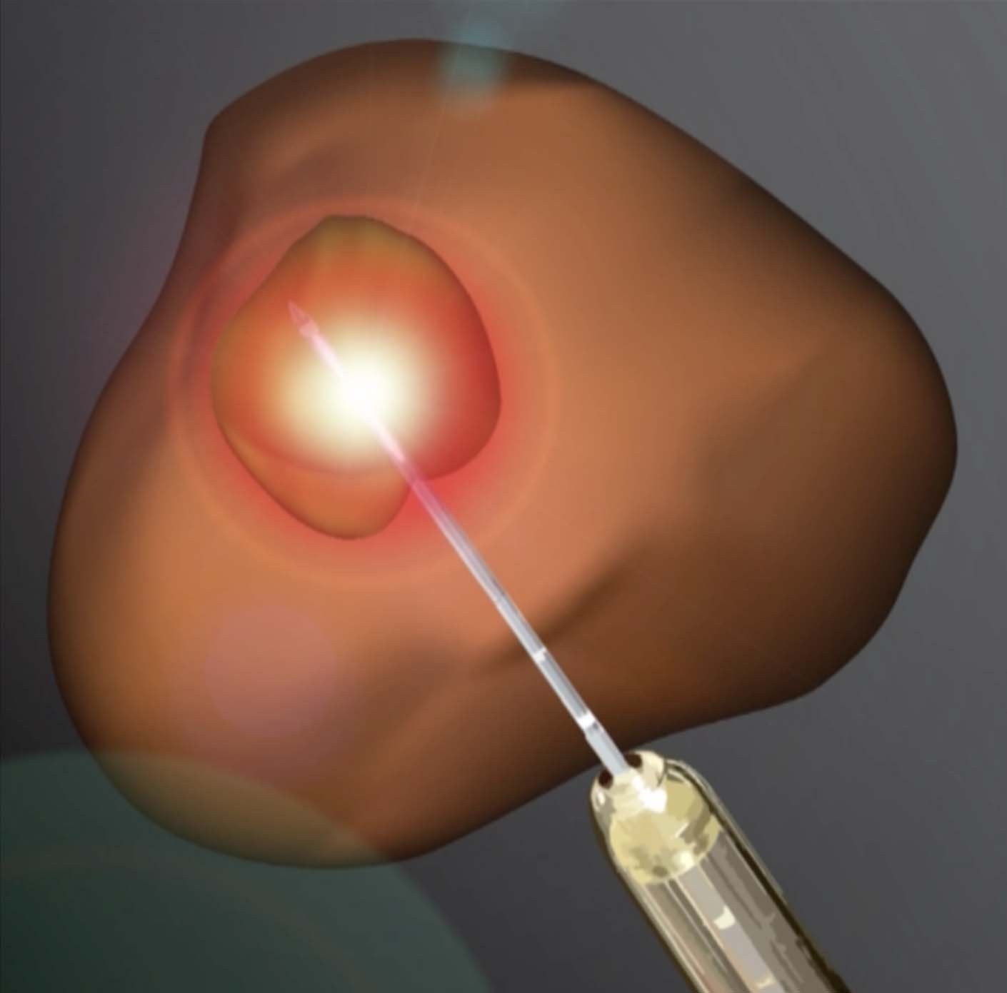 Laser ablation becomes increasingly viable treatment for prostate cancer
