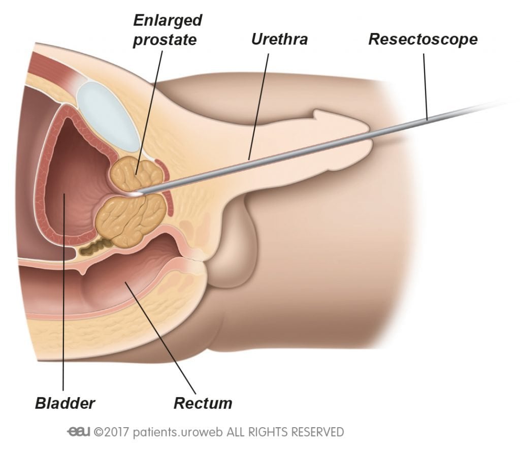 Laser enucleation of the prostate