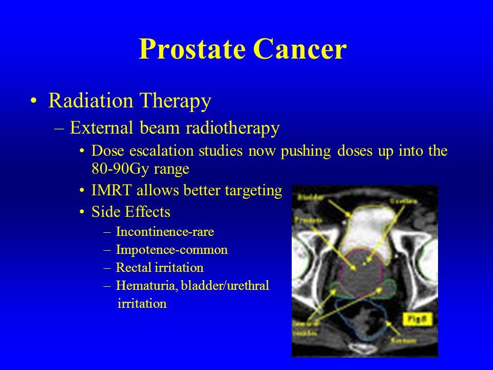 Level 3 Of Prostate cancer