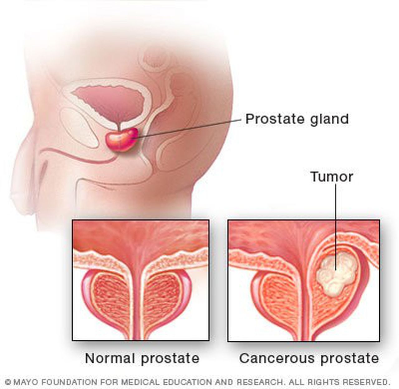 Men should not ignore signs, symptoms of prostate cancer: Linda Rhodes ...