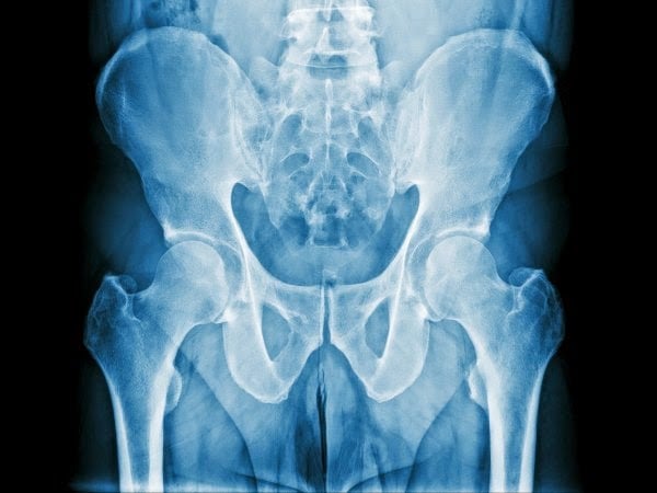 Metástasis ósea del cáncer de próstata