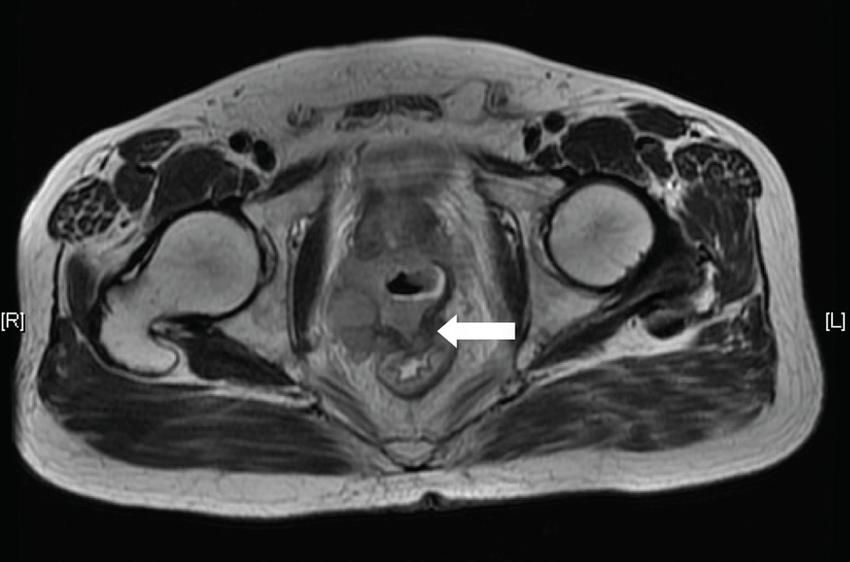 MRI (T2 weighted) showing an enlarged irregular prostate ...