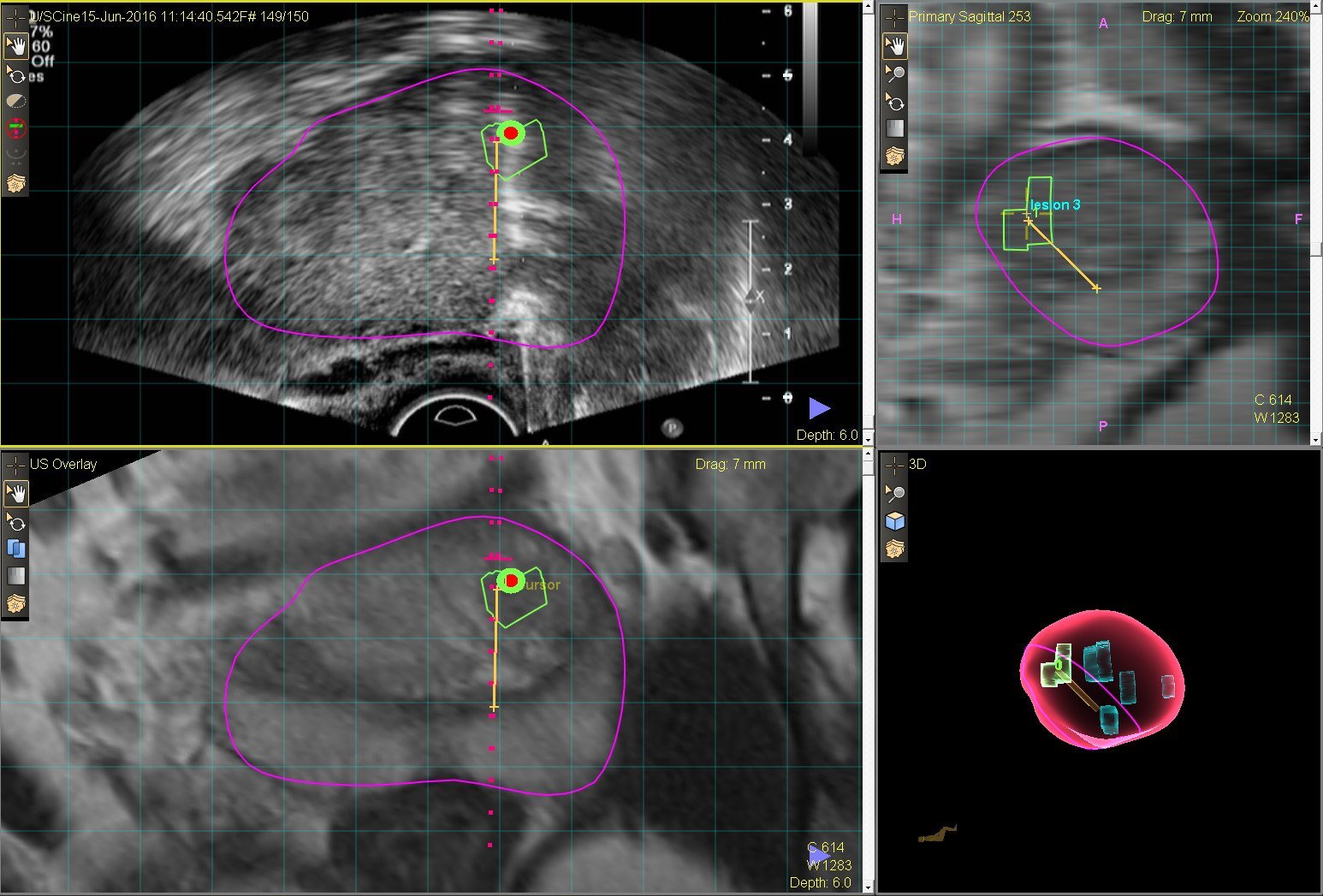 MR/ultrasound fusion guided biopsy of the prostate: a ...