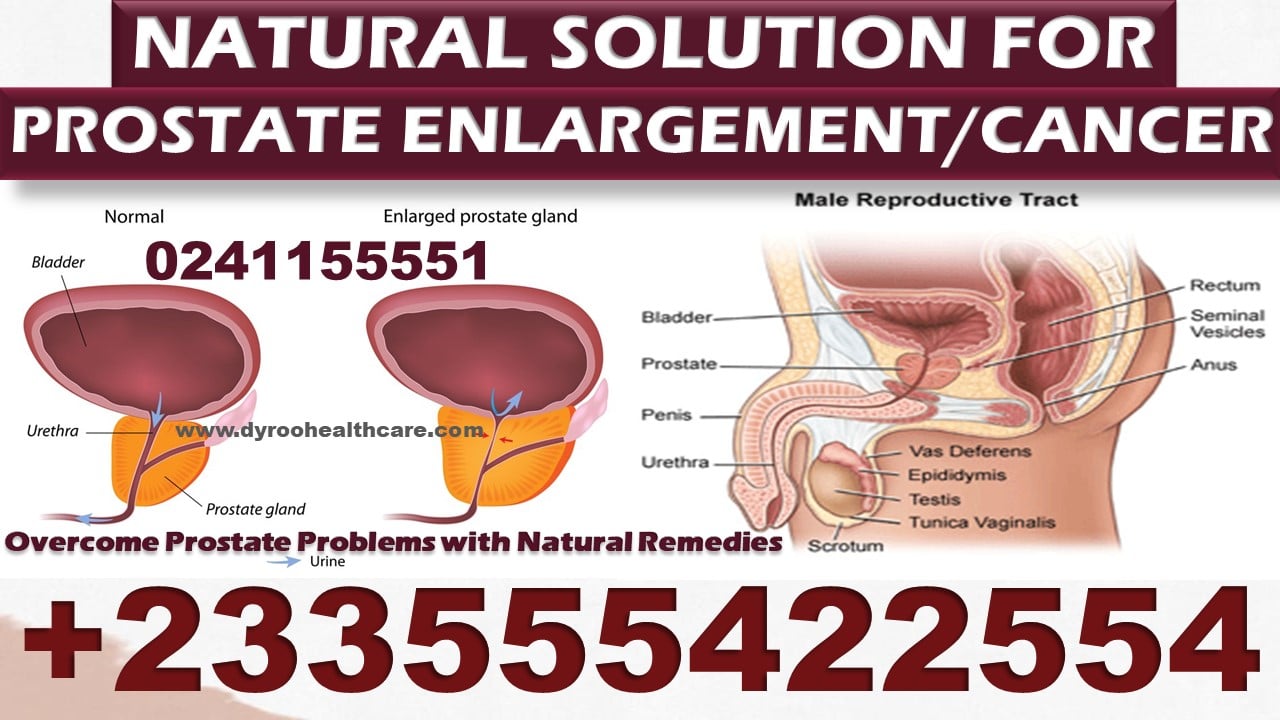 Natural Remedies for Prostate Cancer &  Enlargement