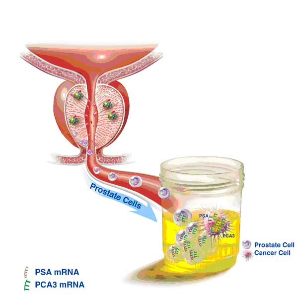 PCA3: Marqueur urinaire du cancer de la prostate