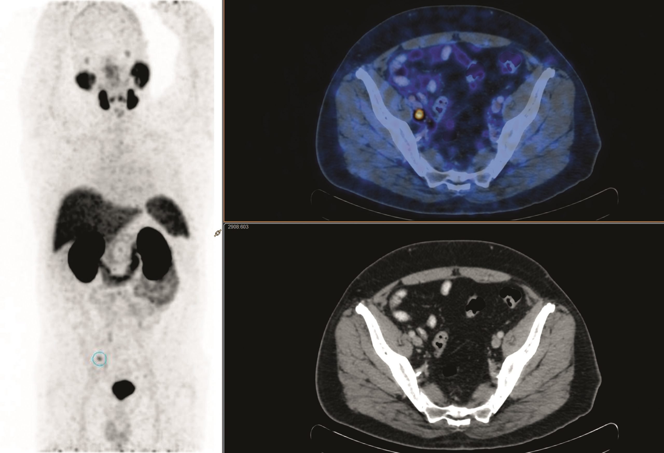 PET Scan Identifies Which Prostate Cancer Patients Can ...