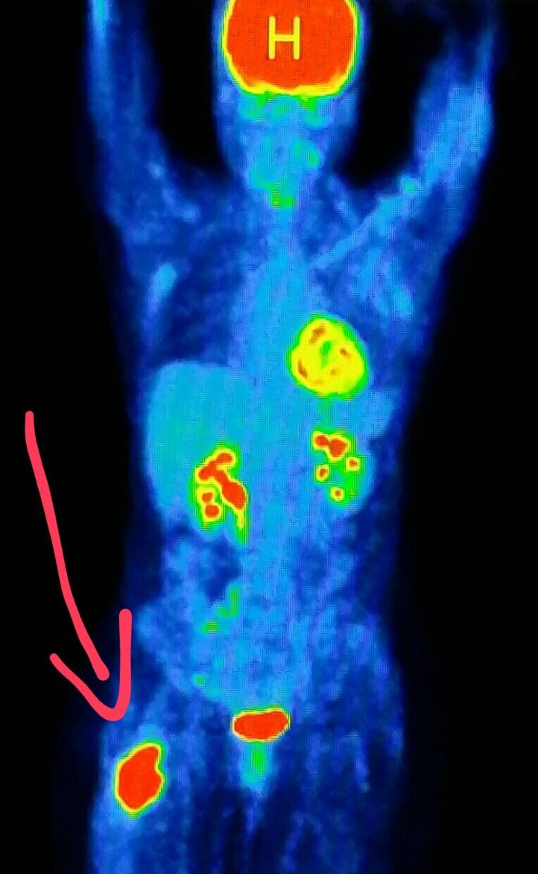 PET scan shows a malignant tumor (cancer) in the hip ...